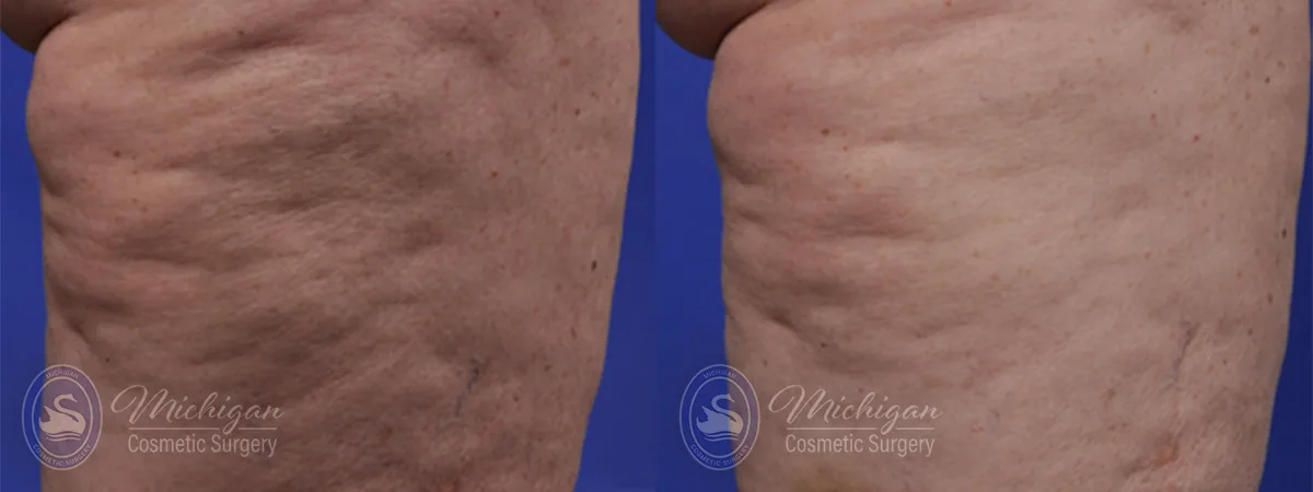 cellulite before after image