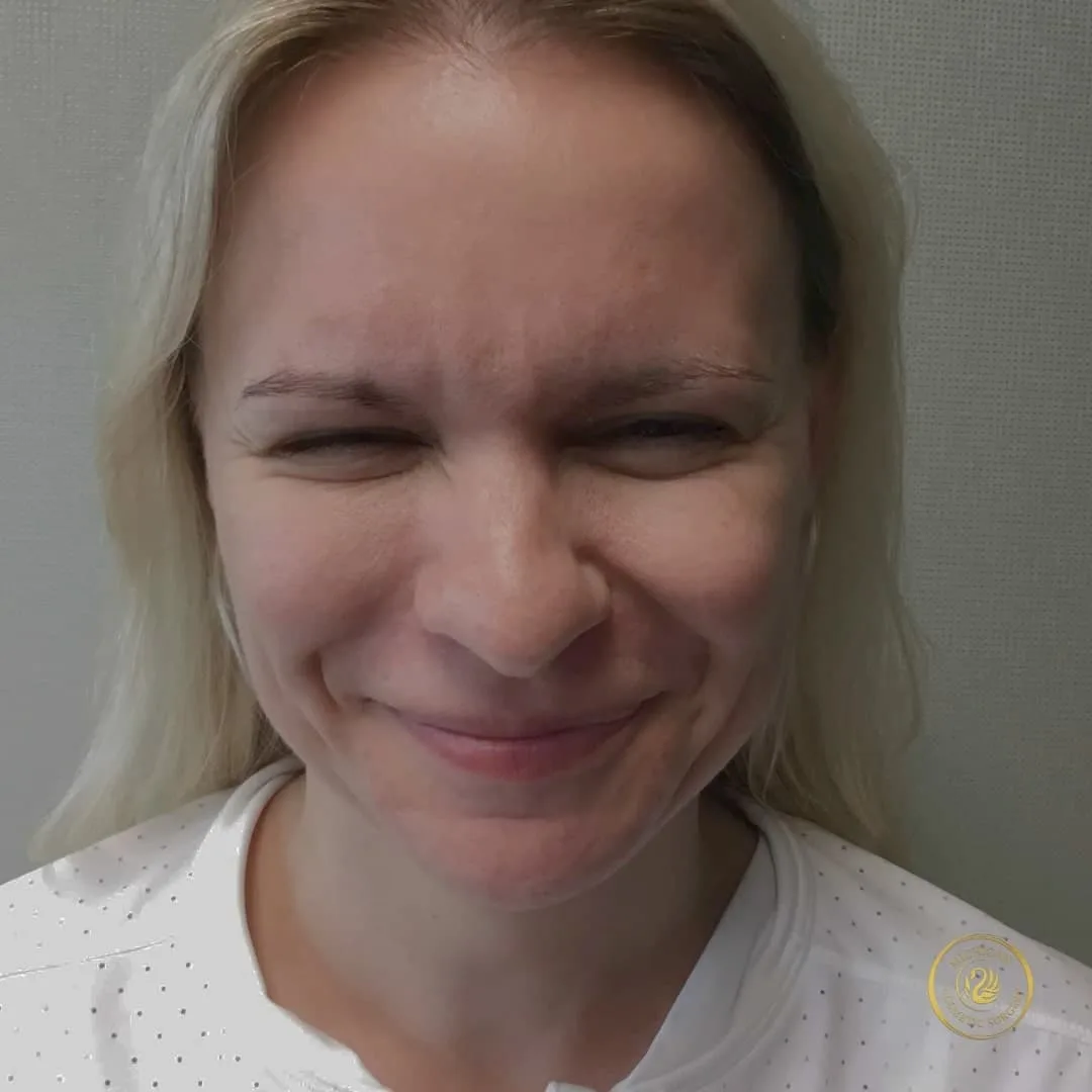 botox after photo by michigan cosmetic surgery in southfield mi