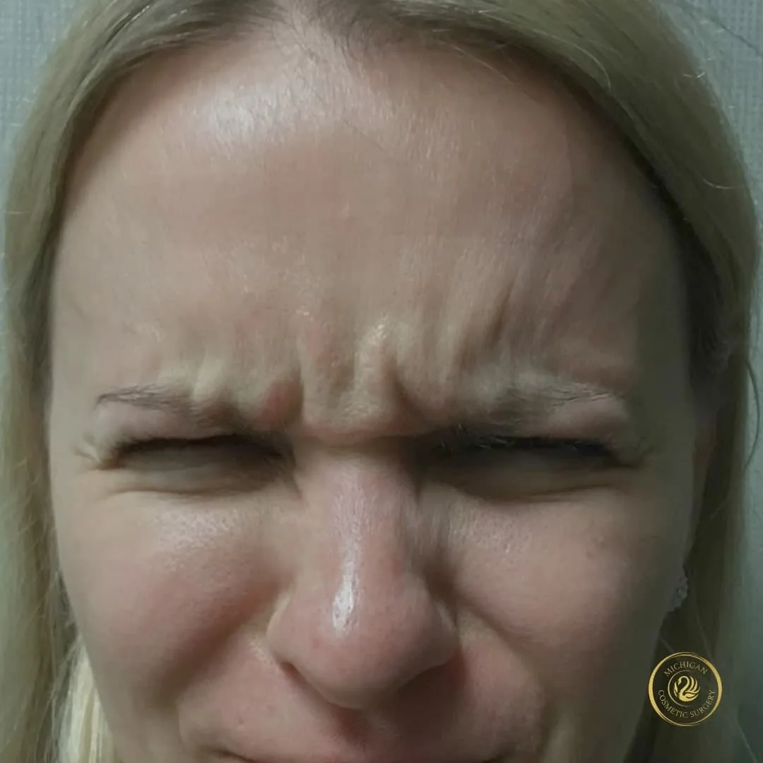 botox before photo by michigan cosmetic surgery in southfield mi