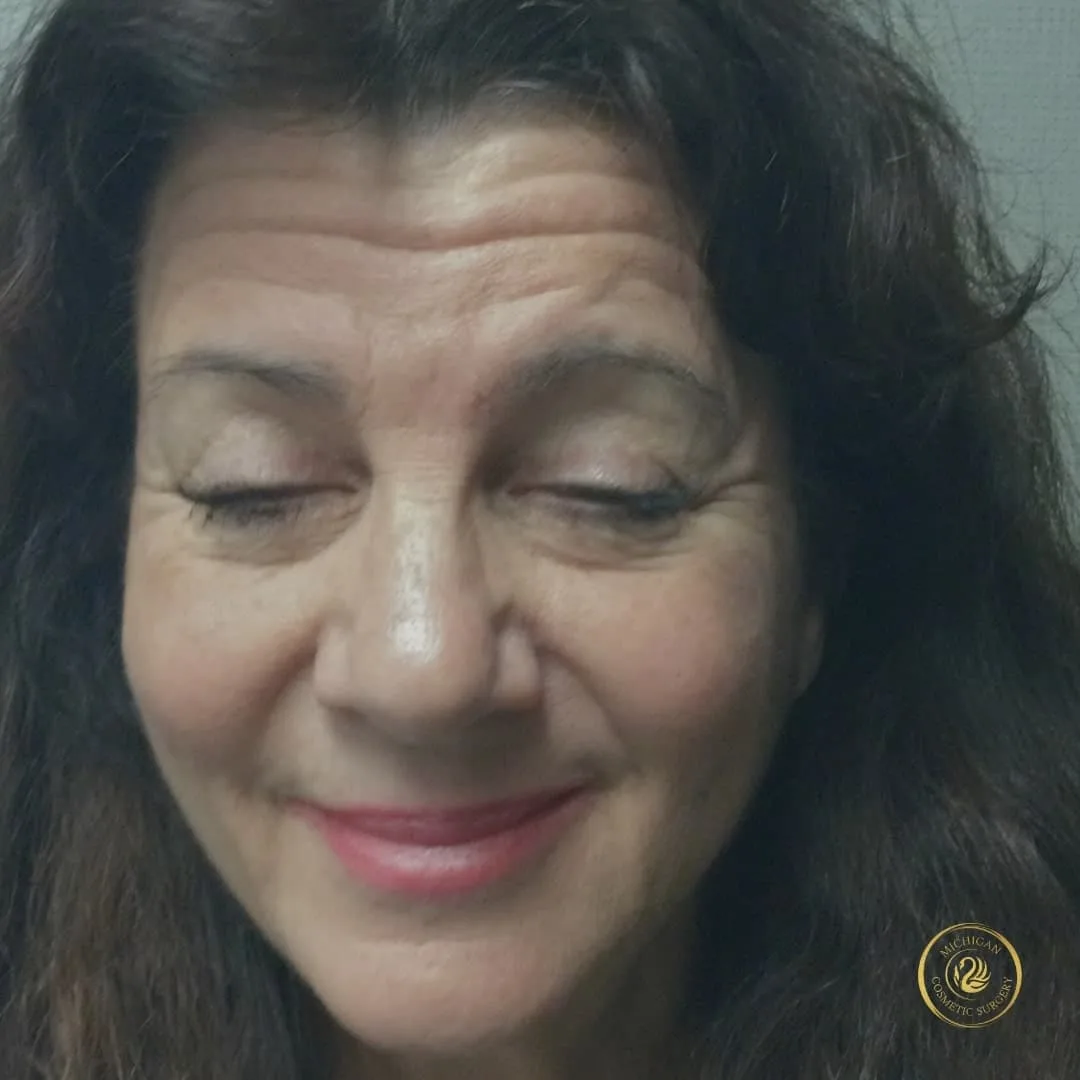 botox before photo by michigan cosmetic surgery in southfield mi