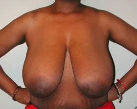 breast reduction before photo by michigan cosmetic surgery in southfield mi