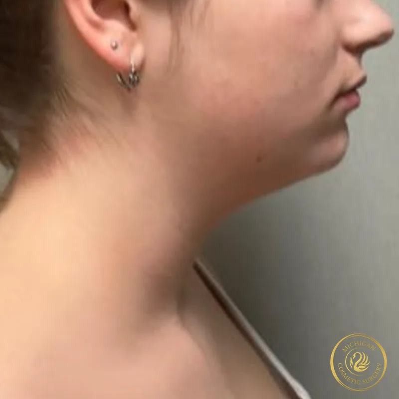 chin liposuction before photo by michigan cosmetic surgery in southfield mi