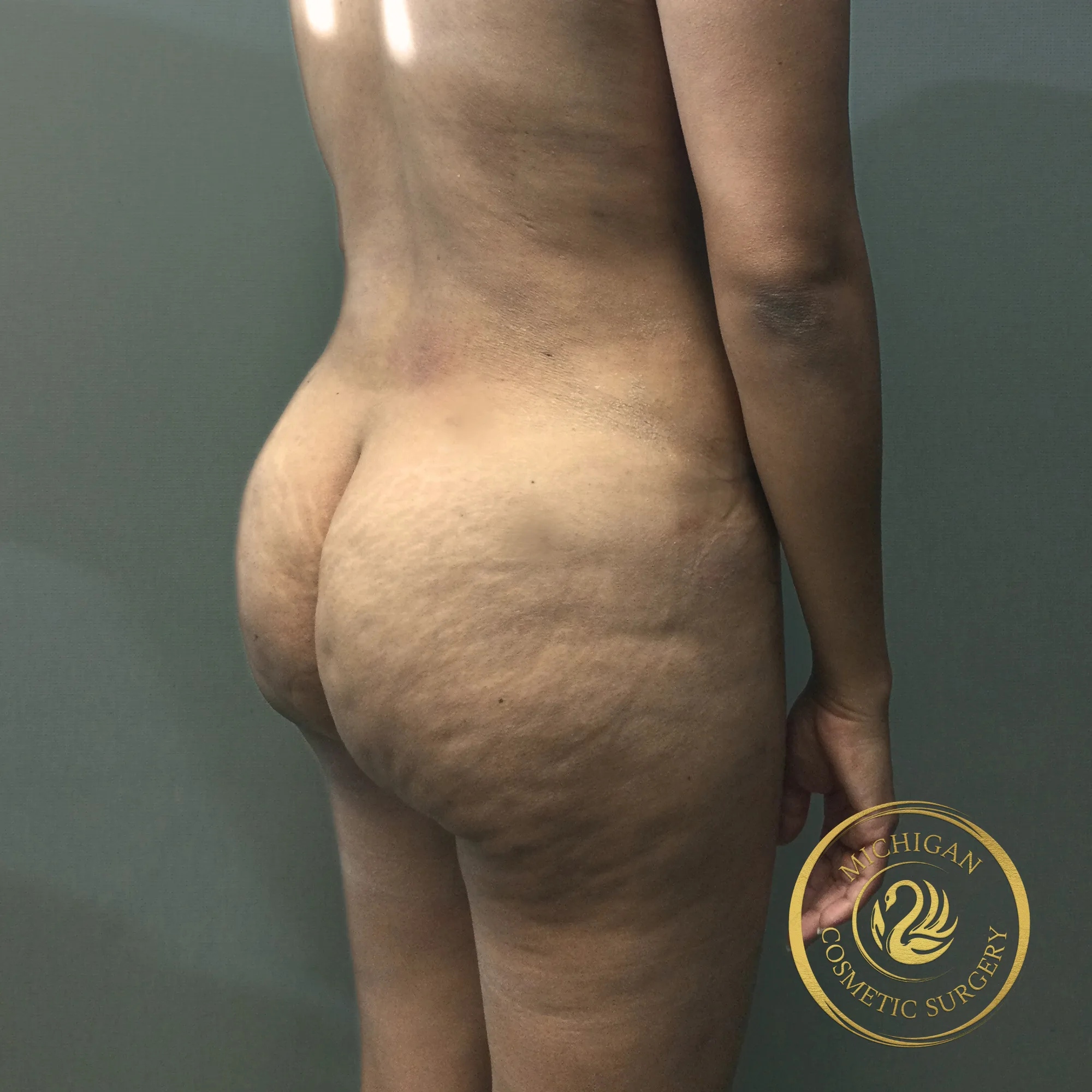 brazilian butt lift after photo by michigan cosmetic surgery in southfield mi