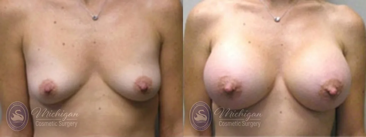 Michigan Cosmetic Surgery Southfield Breast Augmentation P
