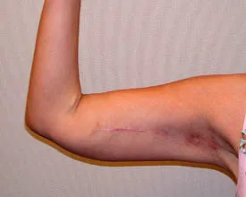 arm lift after photo by michigan cosmetic surgery in southfield mi