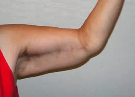 arm lift after photo by michigan cosmetic surgery in southfield mi