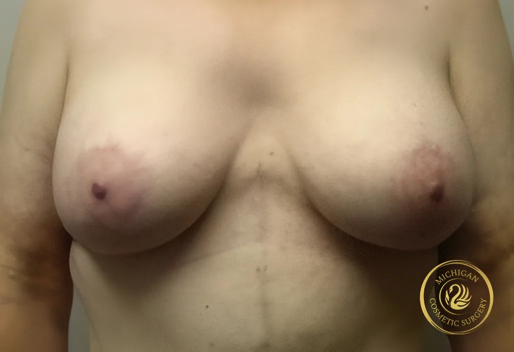 breast augmentation and lift after photo by michigan cosmetic surgery in southfield mi