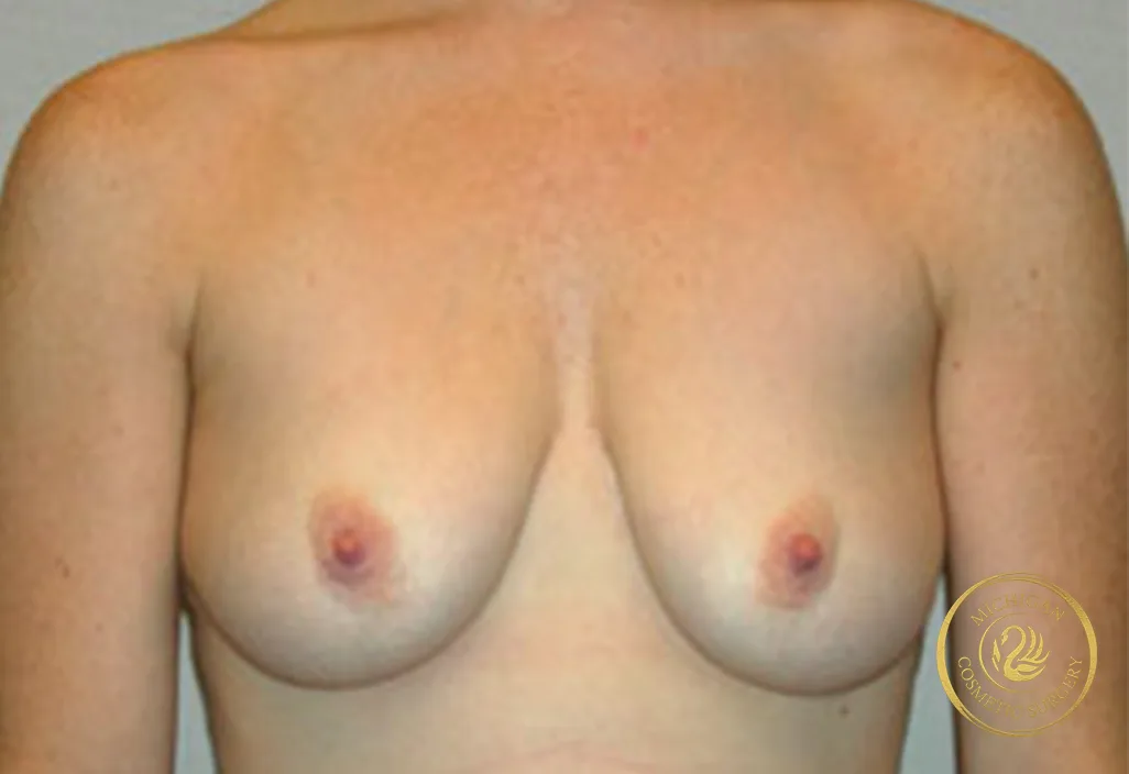 breast augmentation and lift before photo by michigan cosmetic surgery in southfield mi