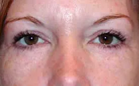 blepharoplasty after photo by michigan cosmetic surgery in southfield mi