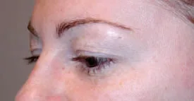 blepharoplasty before photo by michigan cosmetic surgery in southfield mi