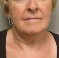facelift before photo by michigan cosmetic surgery in southfield mi