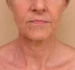 facelift before photo by michigan cosmetic surgery in southfield mi