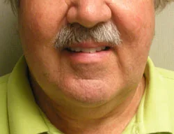 facelift before photo by michigan cosmetic surgery in southfield mi