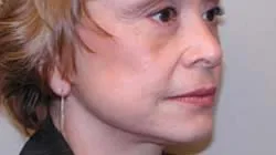 facelift after photo by michigan cosmetic surgery in southfield mi
