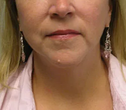 facelift after photo by michigan cosmetic surgery in southfield mi
