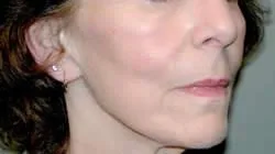 facelift before photo by michigan cosmetic surgery in southfield mi