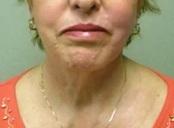 facelift after photo by michigan cosmetic surgery in southfield mi
