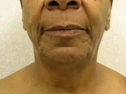 facelift before photo by michigan cosmetic surgery in southfield mi