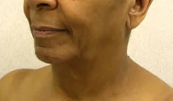 facelift before photo by michigan cosmetic surgery in southfield mi