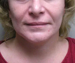facelift after photo by michigan cosmetic surgery in southfield mi