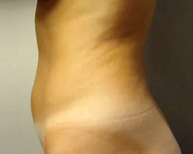 liposuction before photo by michigan cosmetic surgery in southfield mi