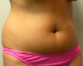 liposuction before photo by michigan cosmetic surgery in southfield mi