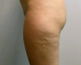 liposuction before photo by michigan cosmetic surgery in southfield mi