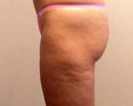 liposuction after photo by michigan cosmetic surgery in southfield mi