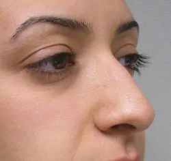 rhinoplasty before photo by michigan cosmetic surgery in southfield mi