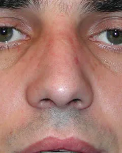 rhinoplasty after photo by michigan cosmetic surgery in southfield mi