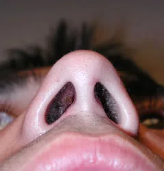 rhinoplasty after photo by michigan cosmetic surgery in southfield mi
