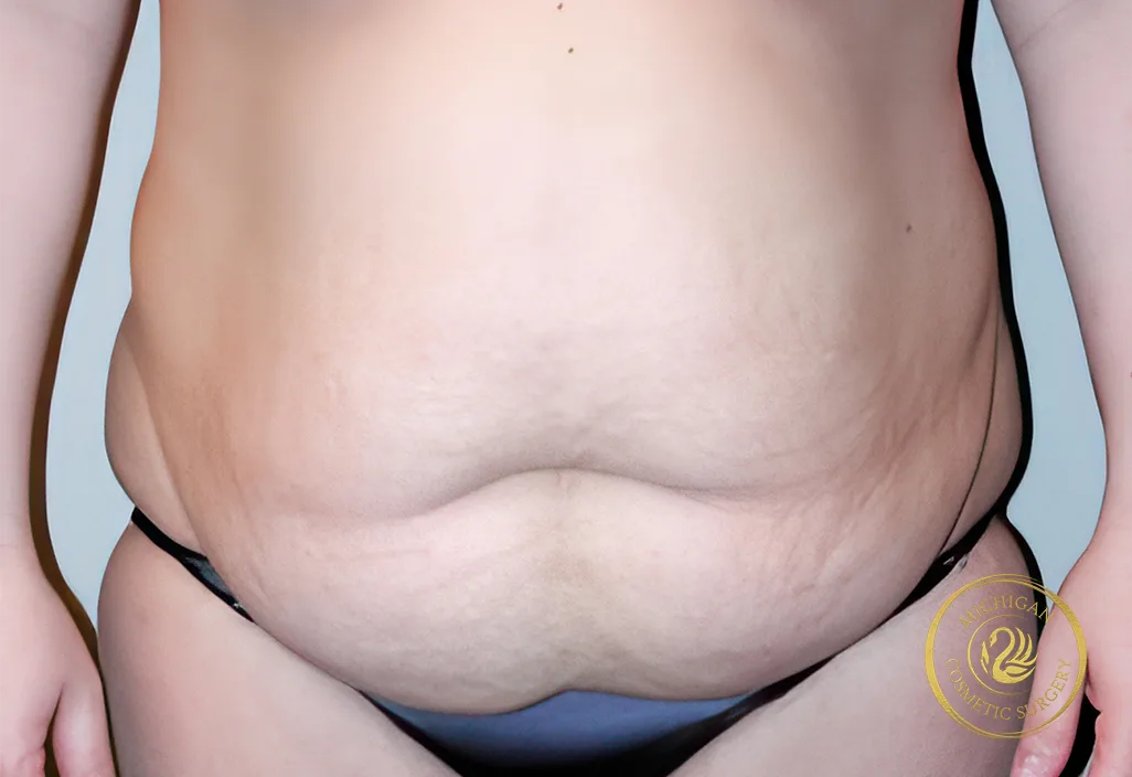 tummy tuck after photo by michigan cosmetic surgery in southfield mi tummy tuck before photo by michigan cosmetic surgery in southfield mi