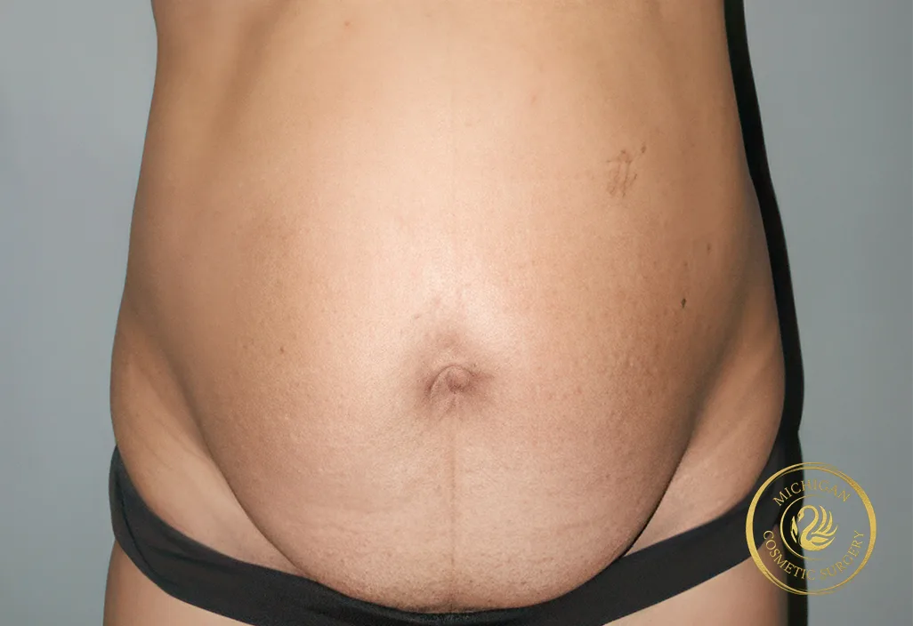 tummy tuck before photo by michigan cosmetic surgery in southfield mi tummy tuck before photo by michigan cosmetic surgery in southfield mi