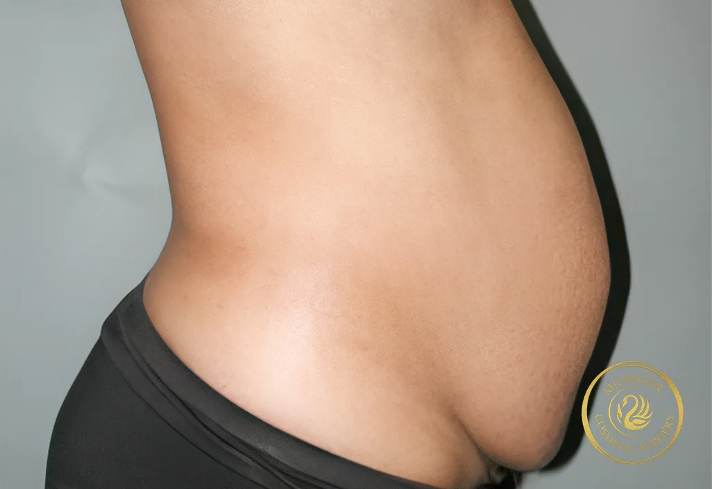 tummy tuck after photo by michigan cosmetic surgery in southfield mi tummy tuck before photo by michigan cosmetic surgery in southfield mi