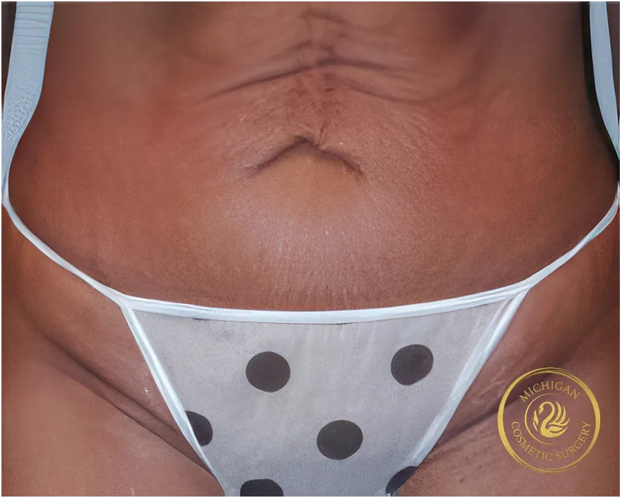tummy tuck before photo by michigan cosmetic surgery in southfield mi tummy tuck before photo by michigan cosmetic surgery in southfield mi