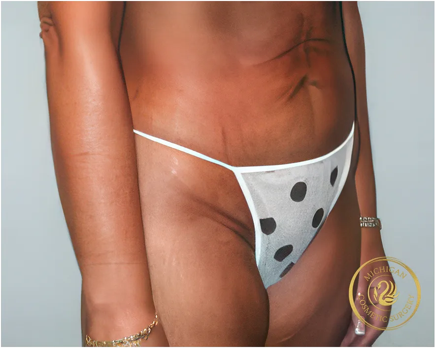 tummy tuck before photo by michigan cosmetic surgery in southfield mi tummy tuck before photo by michigan cosmetic surgery in southfield mi