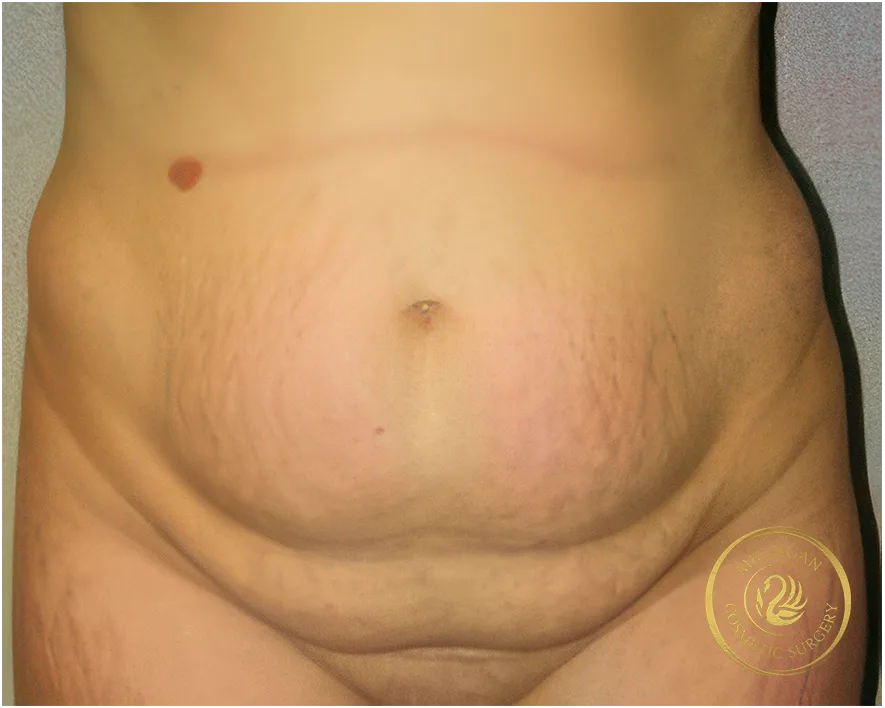 tummy tuck before photo by michigan cosmetic surgery in southfield mi tummy tuck before photo by michigan cosmetic surgery in southfield mi