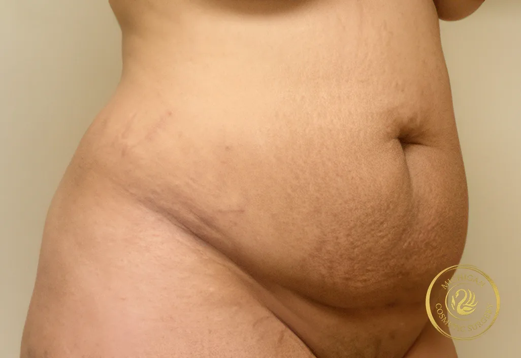 tummy tuck before photo by michigan cosmetic surgery in southfield mi tummy tuck before photo by michigan cosmetic surgery in southfield mi