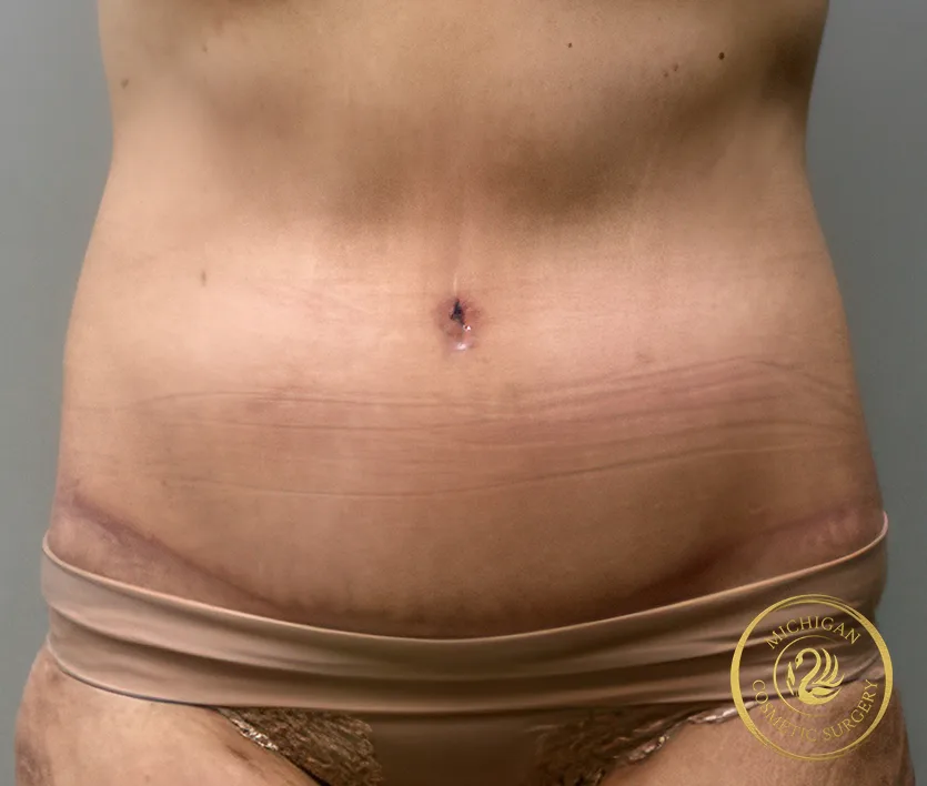 tummy tuck after photo by michigan cosmetic surgery in southfield mi