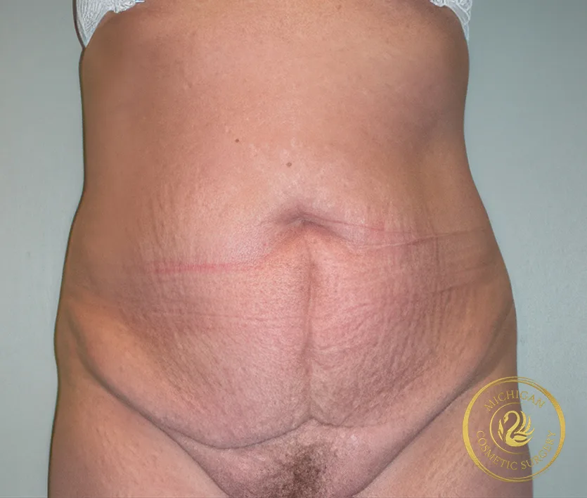 tummy tuck after photo by michigan cosmetic surgery in southfield mi tummy tuck before photo by michigan cosmetic surgery in southfield mi