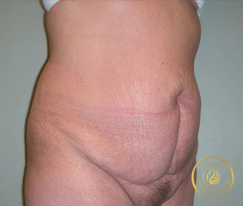 tummy tuck after photo by michigan cosmetic surgery in southfield mi tummy tuck before photo by michigan cosmetic surgery in southfield mi