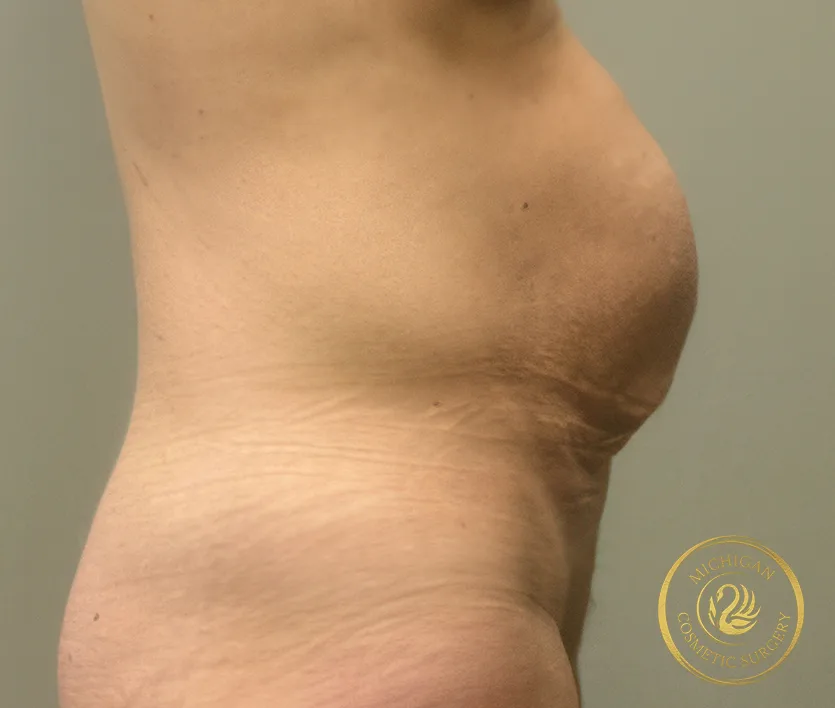 tummy tuck before photo by michigan cosmetic surgery in southfield mi tummy tuck before photo by michigan cosmetic surgery in southfield mi