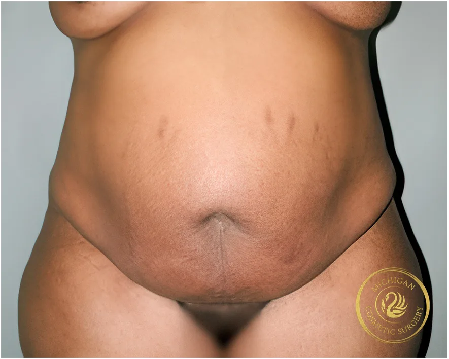 tummy tuck after photo by michigan cosmetic surgery in southfield mi tummy tuck before photo by michigan cosmetic surgery in southfield mi