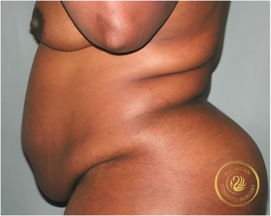 tummy tuck after photo by michigan cosmetic surgery in southfield mi tummy tuck before photo by michigan cosmetic surgery in southfield mi
