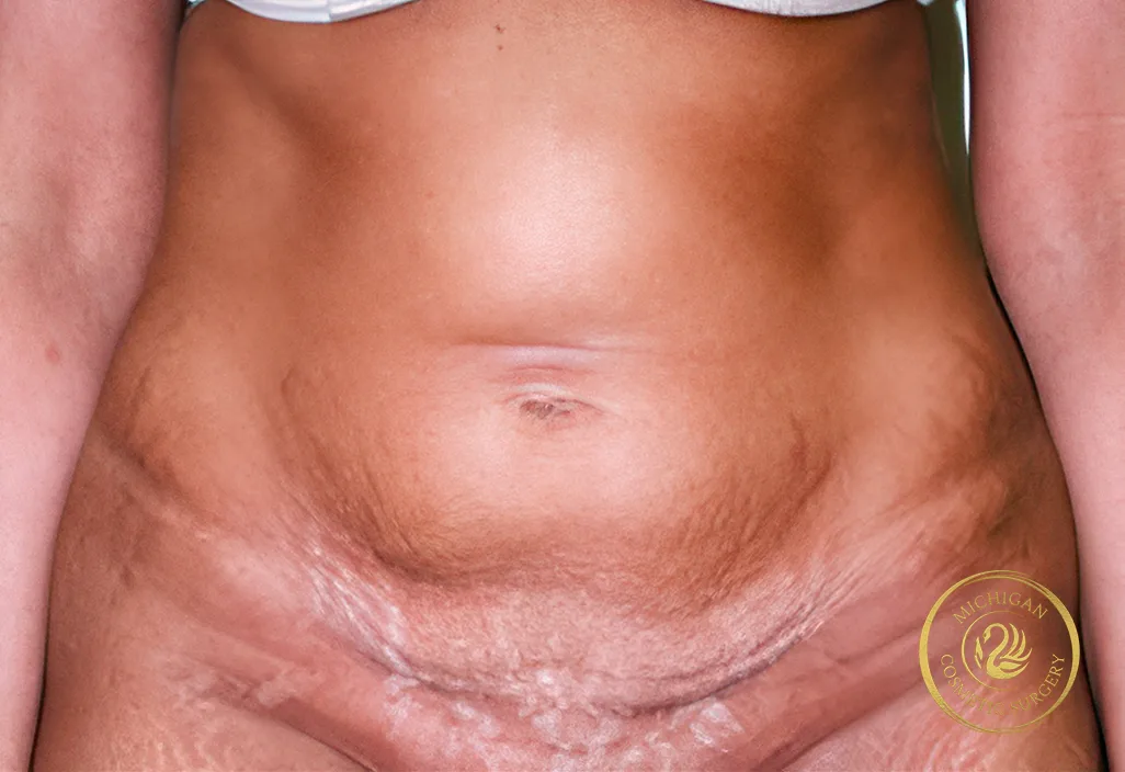 tummy tuck after photo by michigan cosmetic surgery in southfield mi tummy tuck before photo by michigan cosmetic surgery in southfield mi