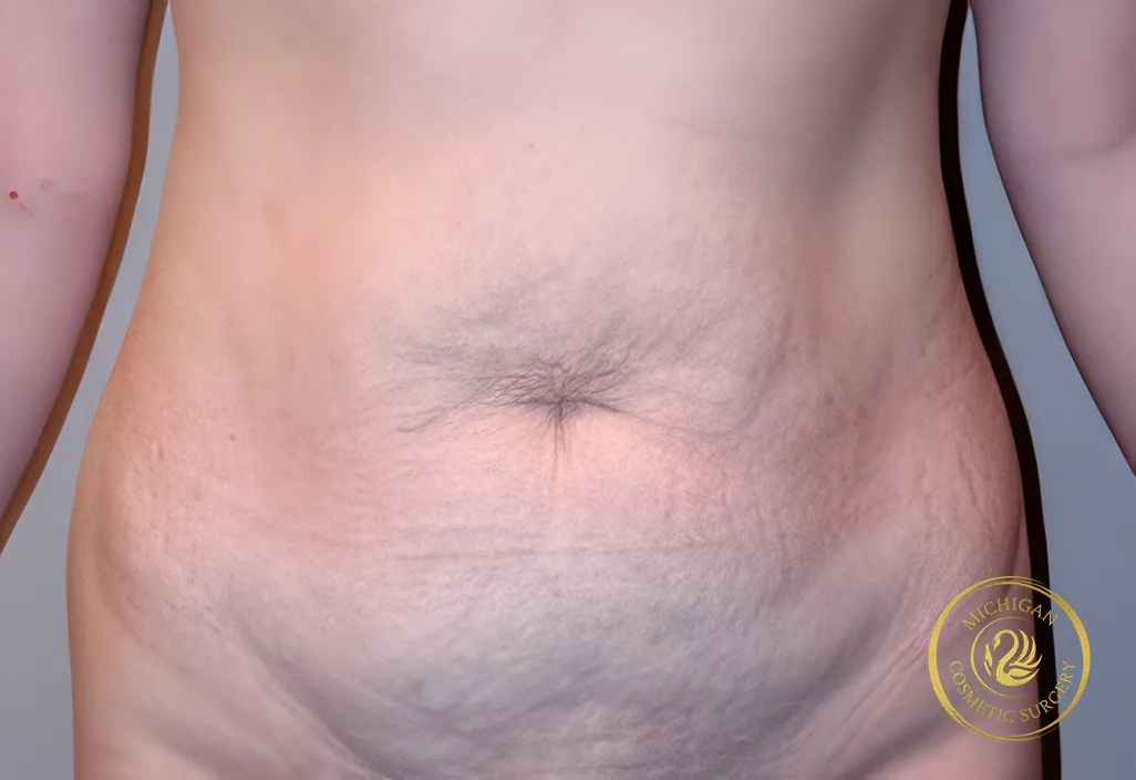tummy tuck after photo by michigan cosmetic surgery in southfield mi tummy tuck before photo by michigan cosmetic surgery in southfield mi