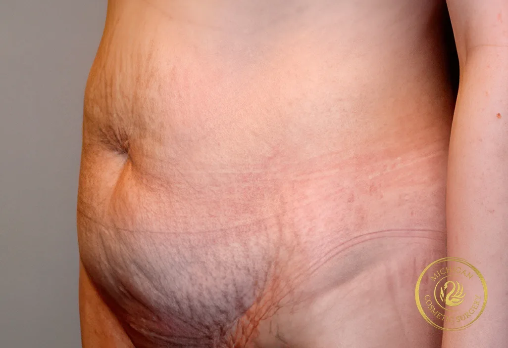 tummy tuck after photo by michigan cosmetic surgery in southfield mi tummy tuck before photo by michigan cosmetic surgery in southfield mi