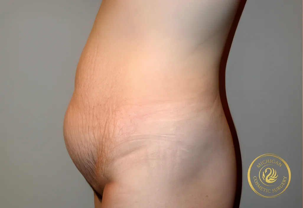 tummy tuck after photo by michigan cosmetic surgery in southfield mi tummy tuck before photo by michigan cosmetic surgery in southfield mi