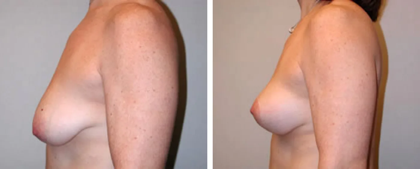 Breast lift c