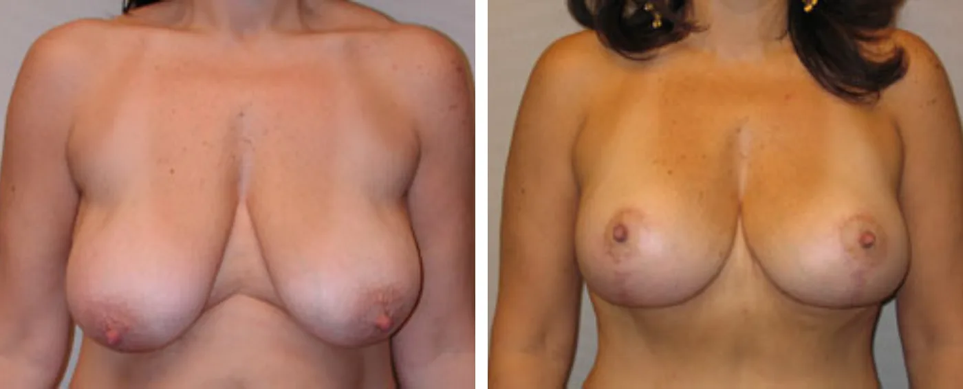 Breast lift a